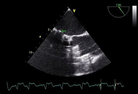 Figure 2 From Prosthetic Valve Endocarditis Successful Management
