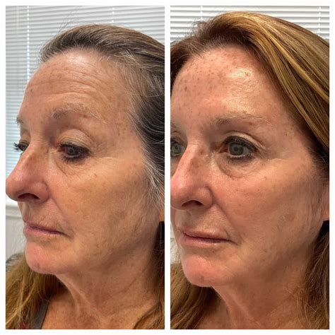 Comprehensive Facial Rejuvenation Before And After St Louis