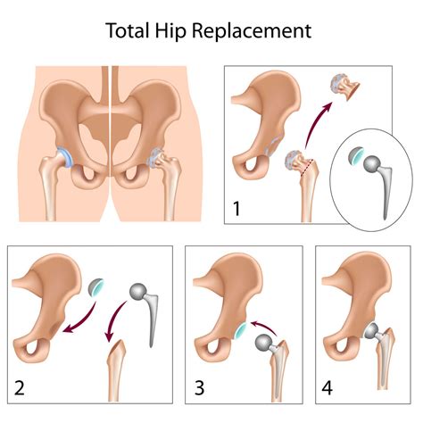 Total Hip Replacement Surgery The Orthopedic And Sports Medicine