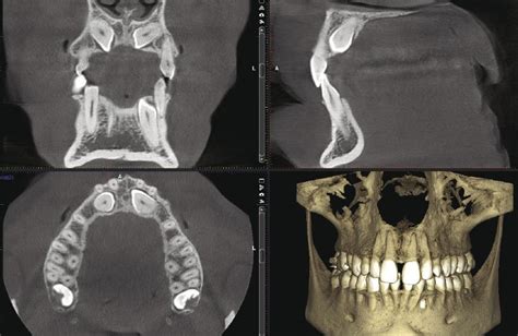 Ct Cone Beam Mandible The Best Picture Of Beam