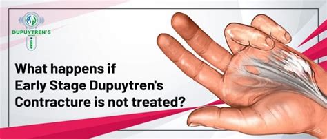 What Happens If Dupuytrens Contracture Is Not Treated