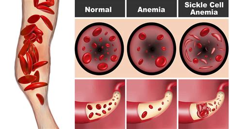 Sickle Cell Anemia Types Causes Symptoms And Treatment My XXX Hot Girl