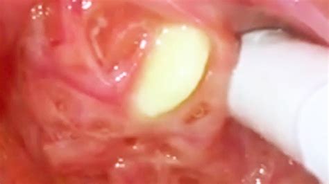 Tonsil Stones Tonsil Stone Or Tonsillolith On The Palm Isolated On