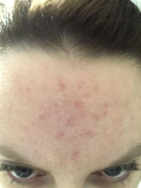 Skin Concerns Routine Help Anyone Else Deal With Small Red Non Acne