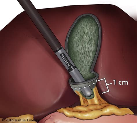 A Step By Step Guide To Laparoscopic Subtotal Fenestrating