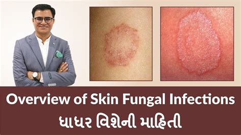 Overview Of Skin Fungal Infections ધાધર વિશેની માહિતી Youtube