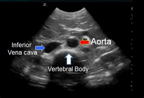 Abdominal Aortic Ultrasound Core Em