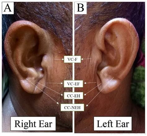 The Bilateral Delc Franks Sign Four Specific Types Of Ear Creases