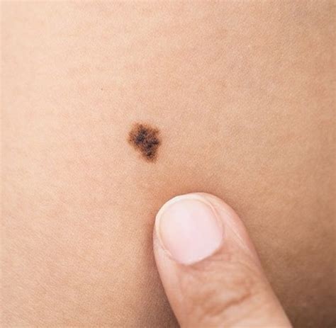Cancerous Mole How To Check If Your Mole Is Possibly Cancerous