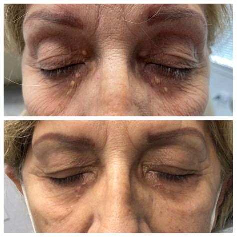 Xanthelasma Treatment St Louis Dermatology And Cosmetic Surgery