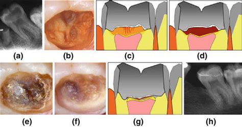 Principal Demonstration Of The Stepwise Excavation Approach Of A Molar