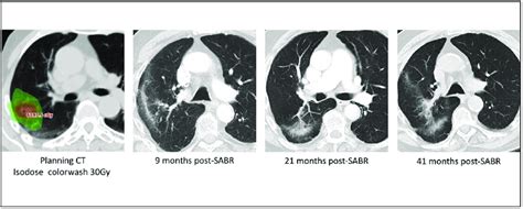 Subpleural Radiation Fibrosis Volumetric Modulated Radiotherapy Plans