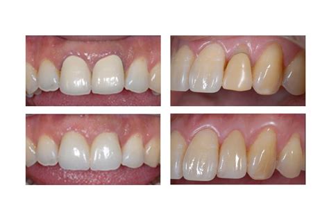 Tooth Colored Restorations And Seamless Dental Restorations