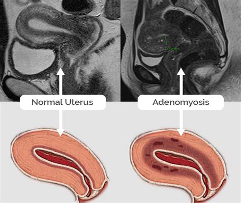 Adenomyosis Images Fibroid Treatment Clinic