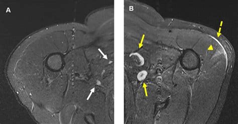 A Covid Vaccine Side Effect Enlarged Lymph Nodes Can Be Mistaken For