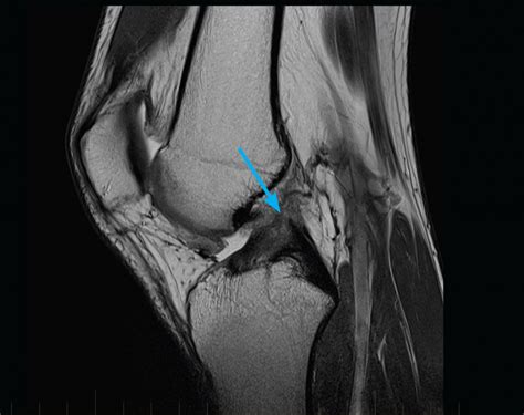 Knee Archives Mri At Melbourne Radiology Clinic