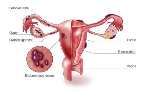 Endometriosis Evolve Women S Health Toowoomba