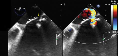 Techniques And Outcomes For The Treatment Of Paravalvular Leak