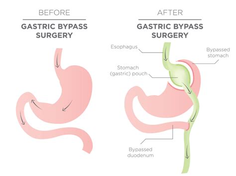 Gastric Sleeve Vs Gastric Bypass What Are The Pros And Cons 2023