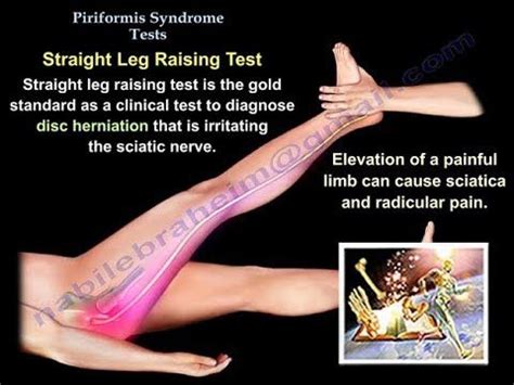 Pin on Back Pain: Sacroilitis