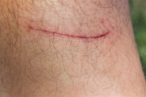 Close Up Of Scratch On Skin Stock Image Image Of Failure Freshness