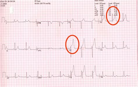 Angina London Cardiovascular Clinic