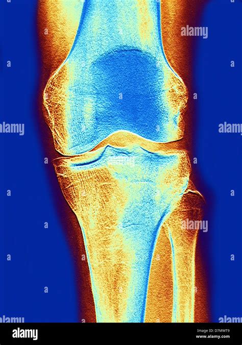 Normal Knee X Ray Hi Res Stock Photography And Images Alamy