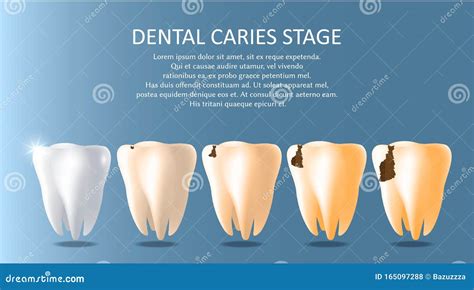 Dental Caries Stages Vector Medical Poster Banner Template Stock Vector
