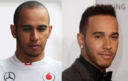 To use the mask, simply work it through your hair after washing it in a hot shower: Has LEWIS HAMILTON had a Hair Transplant? - Celeb Hair ...
