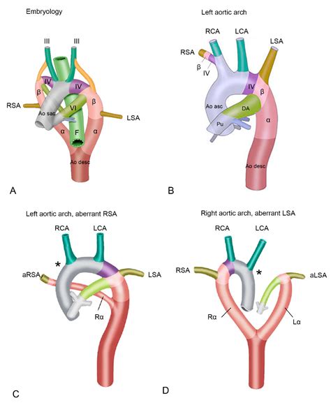 Jcdd Free Full Text The Clinical Spectrum Of Kommerell’s Diverticulum In Adults With A Right