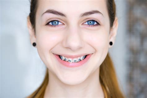 braces in the age of the selfie evergreen orthodontics