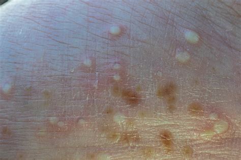 Macro Photo Of Pustules On The Hand Palm Pustular Psoriasis Lesions