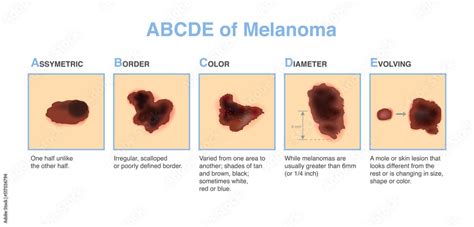 Plakat Different Characteristics Of Skin Damage Abcde Stands For