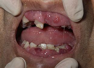 Acute myeloid leukemia - Wikipedia