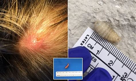 Doctors Remove Two Maggots From A British Womans Scalp Daily Mail Online
