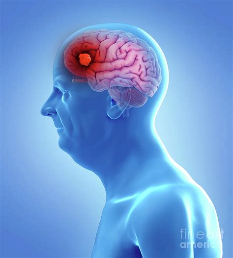 Illustration Of A Brain Tumor Photograph By Sebastian Kaulitzkiscience