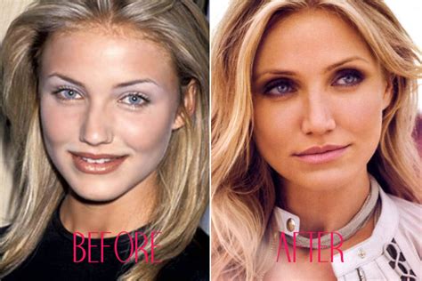Celebrity Nose Jobs Celebrity Noses Before And After