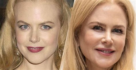 The Undoing Star Nicole Kidmans Fresh Face Plastic Surgeons Weigh In