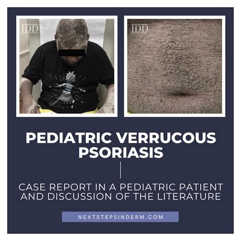 Pediatric Verrucous Psoriasis A Case Report In A Pediatric Patient
