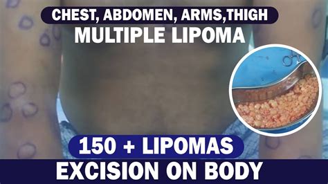 Multiple Lipoma Removal Surgery Lipoma Excision From Chest Abdomen