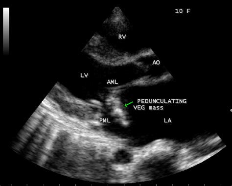 Flail Anterior Mitral Leaflet With A Pedunculated Partially Calcified