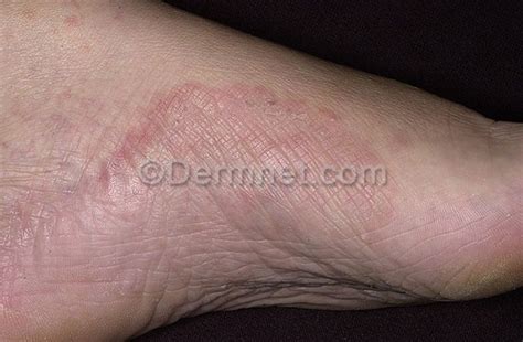 We did not find results for: Tinea (Ringworm) Foot Plantar Photo - Skin Disease Pictures