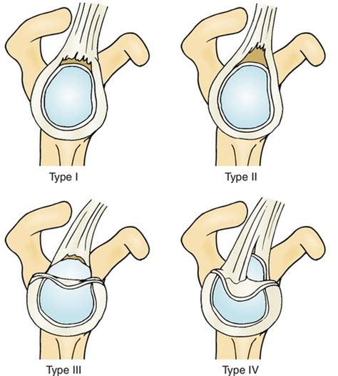 Traumatic injury to the shoulder or overuse of the shoulder by excessive throwing or weightlifting can cause a labral tear. Informe radiológico: Clasificación de las lesiones SLAP ...