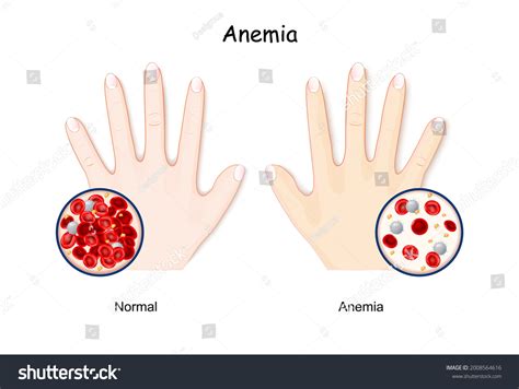 Anemia Hand Healthy Human Anaemia Decrease Stock Vector Royalty Free