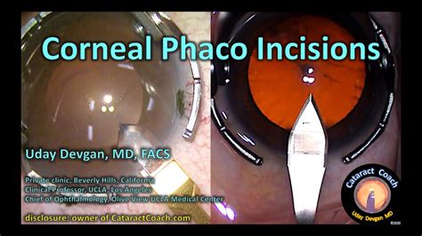 Compilation Video Corneal Phaco Incisions For Cataract Surgery Youtube