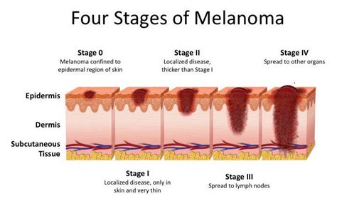 Stage 4 Melanoma Skin Cancer