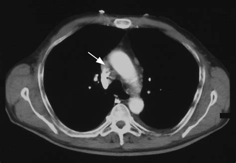 Ct Scan Of Chest Showing Enlarged Para Aortic Lymph Node Scientific