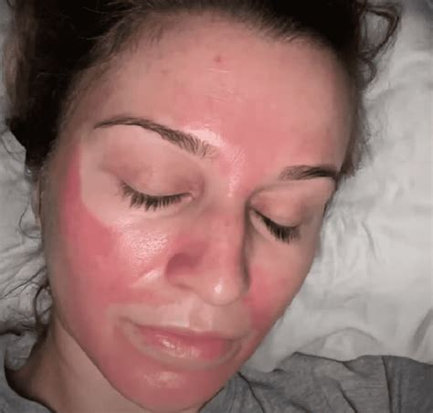 Chemical Peel Gone Wrong 3 Cases To Learn From Blushastic