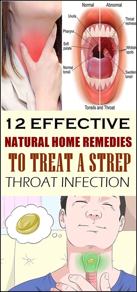 12 Effective Natural Home Remedies To Treat A Strep Throat Infection Throat Infection Strep
