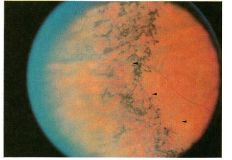 Peripheral Retina Ofpatient Ill I Coarse Pigmentary Retinopathy With A